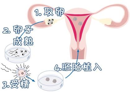 关于 试管捐卵机构